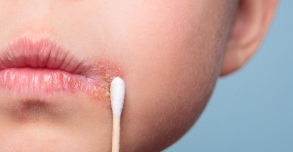 cold sore blisters Cold Sores Stages symptoms