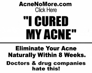Acne Home Remedies