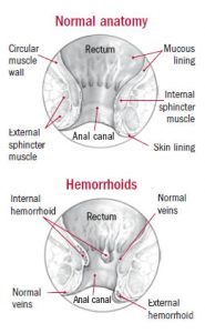 What Do Hemorrhoids Look Like (Piles) - Symptoms, Selfcare & Treatment