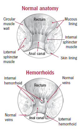 Normal anatomy Vs Hemorrhoids