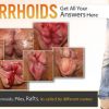 What Do Hemorrhoids (Piles) Look Like?
