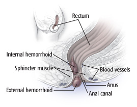 hemorroids internal external