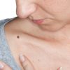 How To Get Rid Of Moles On Face – 100% Foolproof Way