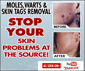 Get Rid Of Moles & Warts Treatment guide