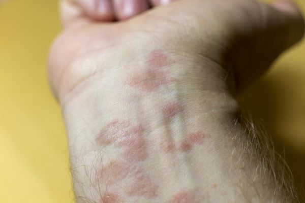 Allergic eczema