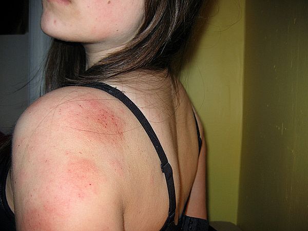 how to treat eczema fast