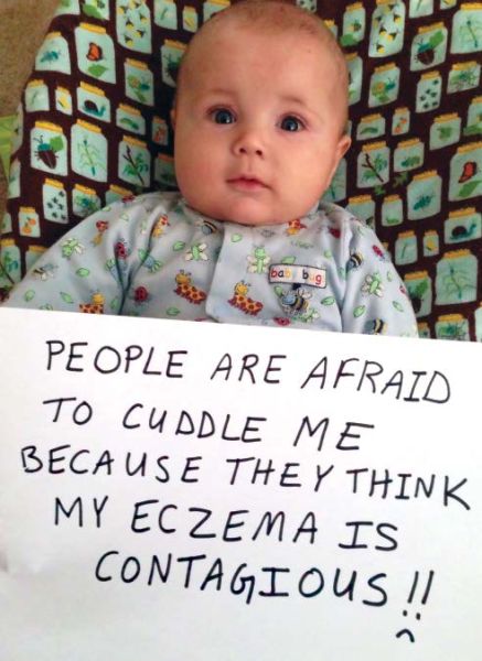 eczema non-contagious