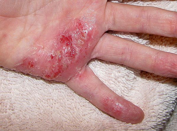 Home Remedies For Eczema