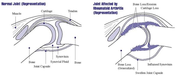 Rheumatoid Arthritis