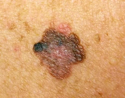 get rid of moles cancer