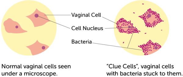 Normal vaginal cells vs. Clue cells