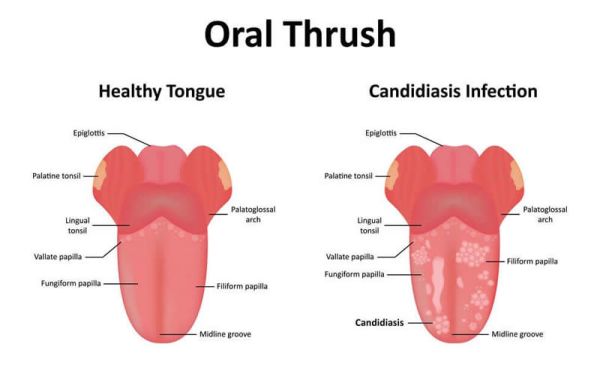 mouth oral thrush candida albicans