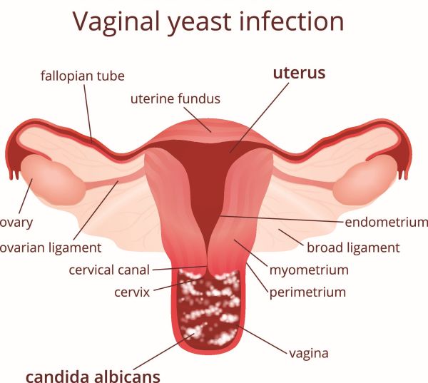 vaginal yeast infection thrush